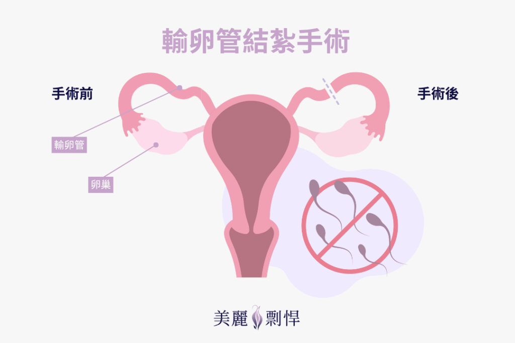 婦產科輸卵管結紮手術流程示意:手術前後輸卵管阻斷對照圖