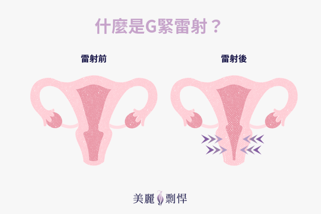 什麼是G緊雷射?示意圖比較治療前後陰道與骨盆支持組織的緊實變化