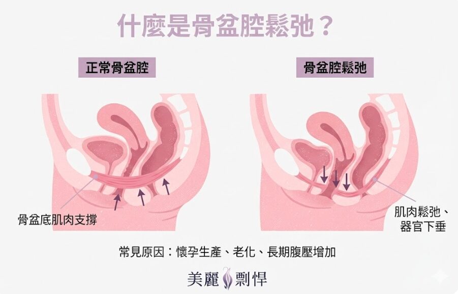 骨盆腔鬆弛常見原因