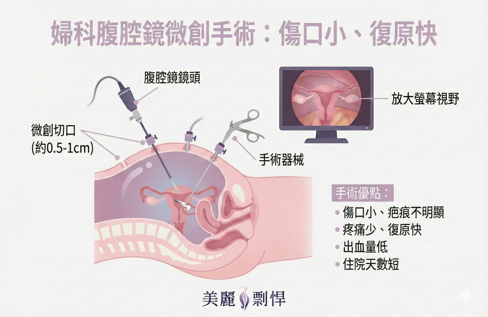 腹腔鏡微創手術完整指南：婦科手術新選擇